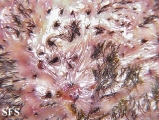 folliculitis decalvans