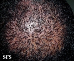 folliculitis decalvans