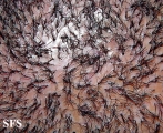 folliculitis decalvans