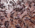 folliculitis decalvans