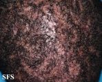 folliculitis decalvans
