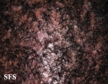 folliculitis decalvans