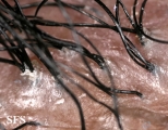folliculitis decalvans