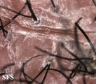 folliculitis decalvans