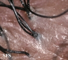 folliculitis decalvans