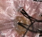 folliculitis decalvans