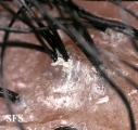 folliculitis decalvans