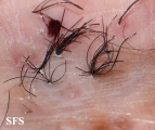 folliculitis decalvans
