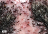folliculitis decalvans