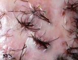 folliculitis decalvans