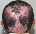 folliculitis decalvans