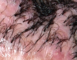 folliculitis decalvans