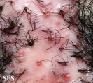 folliculitis decalvans