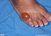 diabetic_bullae