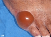 diabetic_bullae