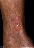 diabetic_bullae