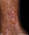 diabetic_bullae