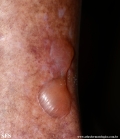 diabetic_bullae