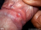 syphilis primary-chancre