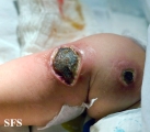 ecthyma gangrenosum