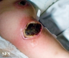 ecthyma gangrenosum