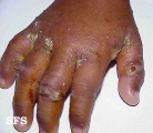 scabies-secondary infection