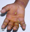 scabies-secondary infection