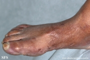 leprosy borderline