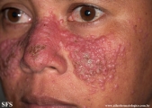 rosacea-granulomatous_rosacea