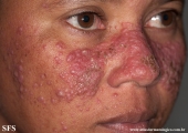 rosacea-granulomatous_rosacea