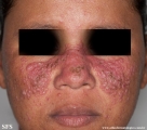 rosacea-granulomatous_rosacea