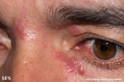 rosacea-granulomatous_rosacea