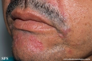 rosacea-granulomatous_rosacea