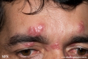 rosacea-granulomatous_rosacea