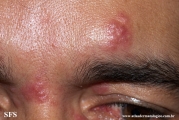 rosacea-granulomatous_rosacea