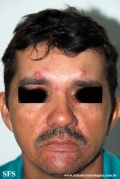 rosacea-granulomatous_rosacea