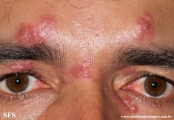 rosacea-granulomatous_rosacea