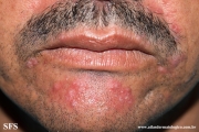 rosacea-granulomatous_rosacea