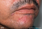 rosacea-granulomatous_rosacea