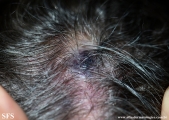 angiosarcoma