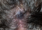 angiosarcoma