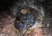 angiosarcoma