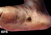 angiosarcoma