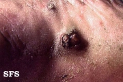angiosarcoma