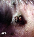 angiosarcoma