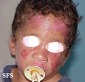 bloom syndrome