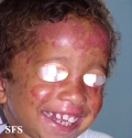 bloom syndrome