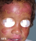 bloom syndrome