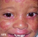 bloom syndrome