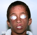 bloom syndrome